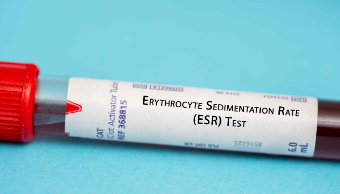 Understanding Elevated ESR Levels: Causes and Considerations ...